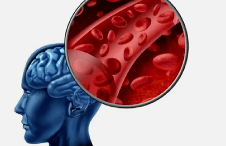 Sintomi dell'osteocondrosi del rachide cervicale