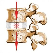 Il dispositivo della colonna vertebrale e le cause dell'osteocondosi
